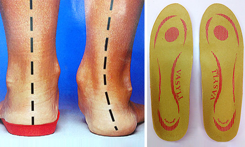 特色治療-醫療鞋墊